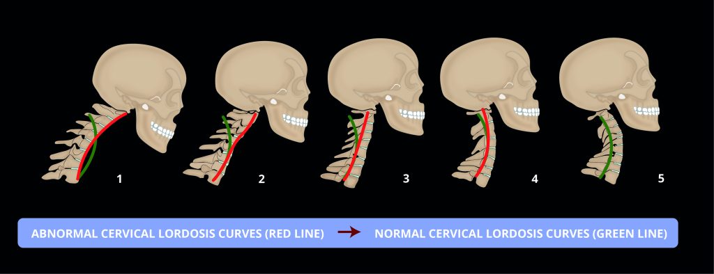 Straight Neck? - GETTING SPINES HEALTHY AGAIN