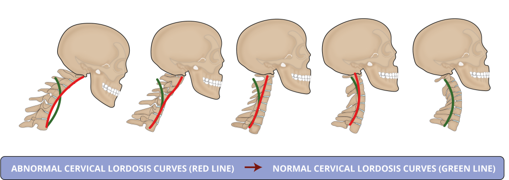 Normal cervical neck curve
